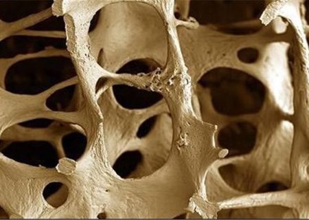 چه کسانی بیشتر در معرض پوکی استخوان هستند ؟